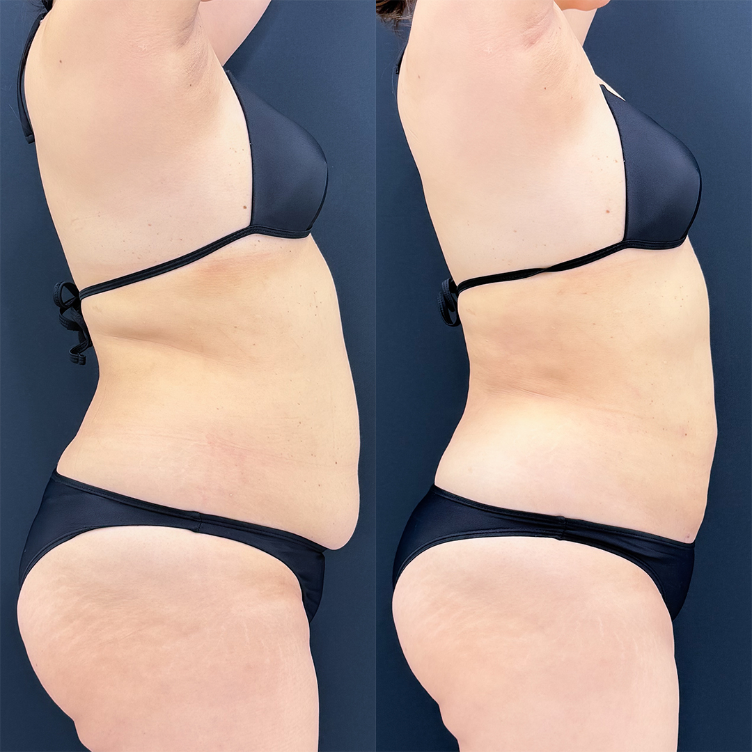 https://purelys-tokyo-clinic.com/wp/wp-content/uploads/2026/03/Before-and-After-abdominal-Liposuction_Case-No.360.jpg
