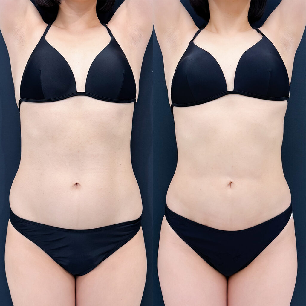 お腹の脂肪吸引