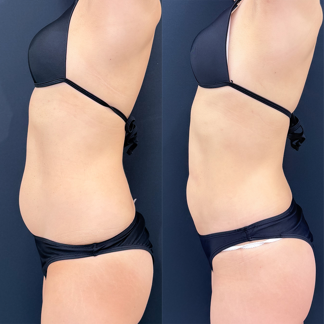 https://purelys-tokyo-clinic.com/wp/wp-content/uploads/2026/03/Before-and-After-abdominal-Liposuction_Case-No.362.jpg