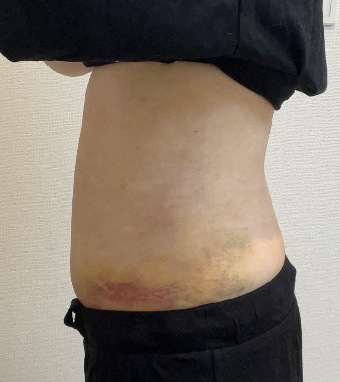 お腹の脂肪吸引