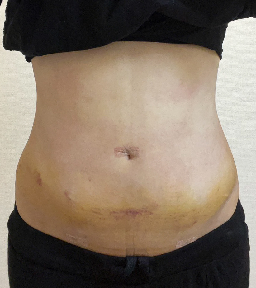 お腹の脂肪吸引