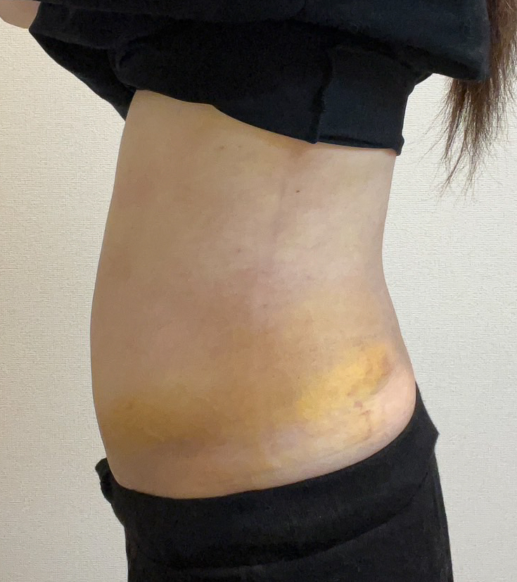 お腹の脂肪吸引