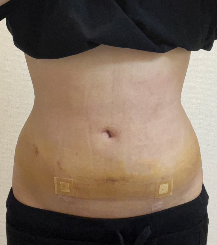 お腹の脂肪吸引