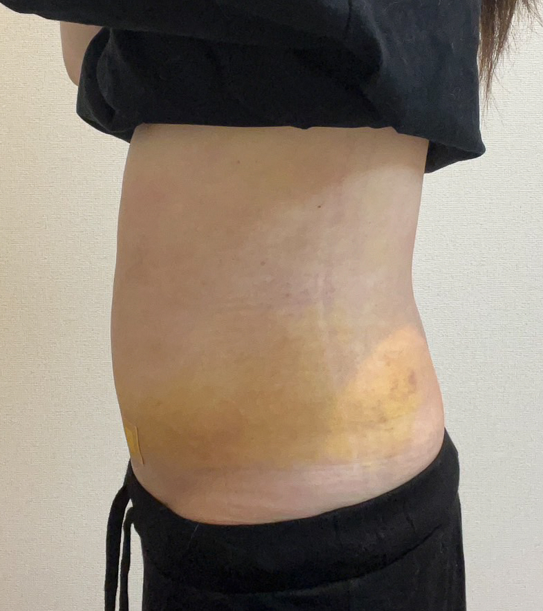 お腹の脂肪吸引