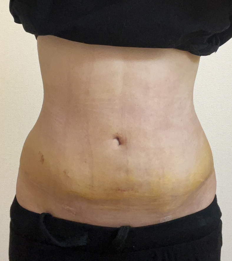 お腹の脂肪吸引