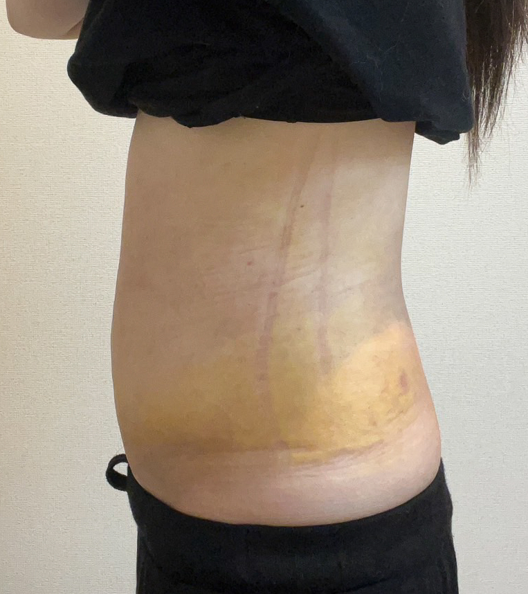 お腹の脂肪吸引
