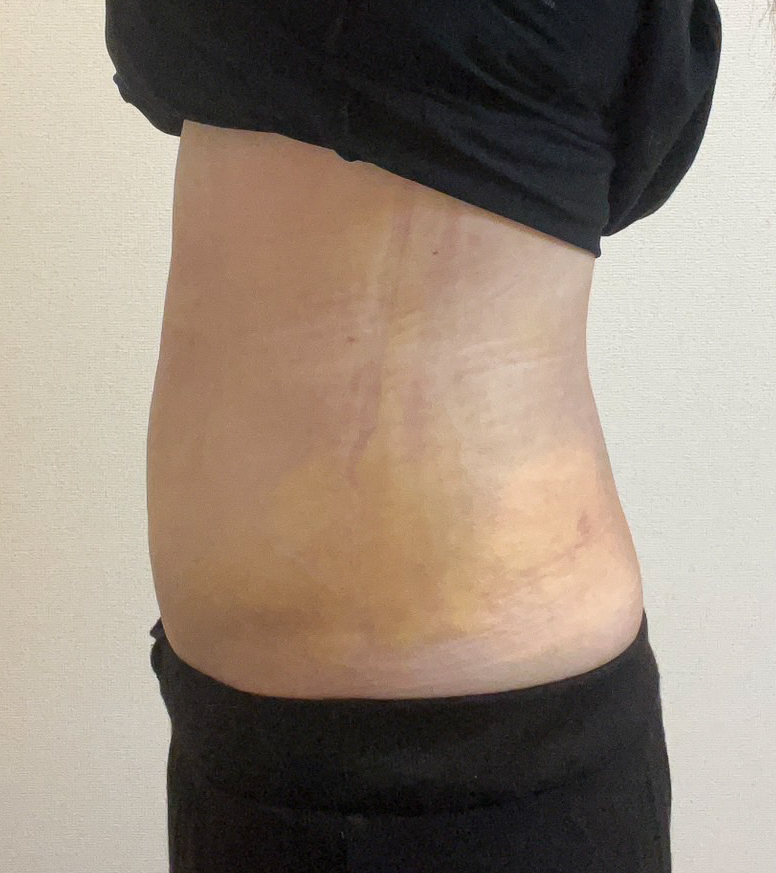お腹の脂肪吸引