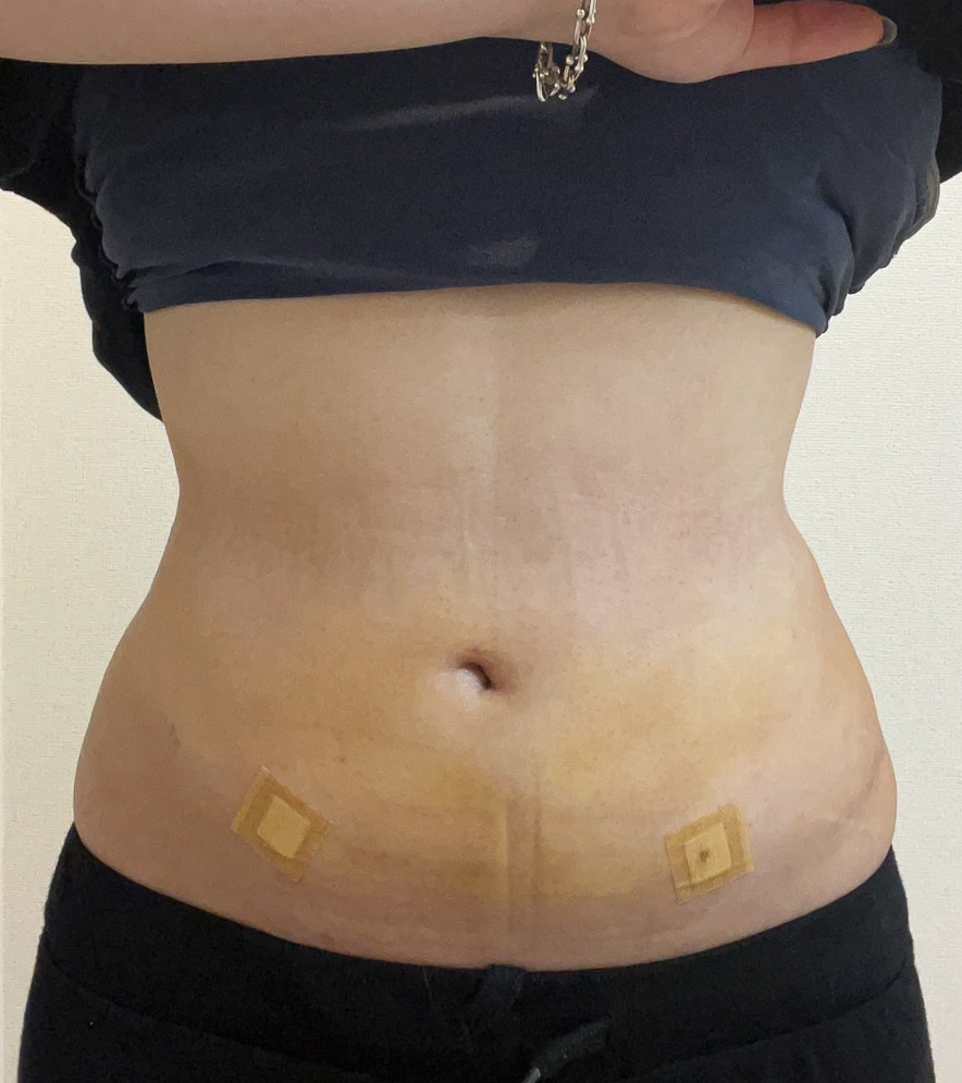 お腹の脂肪吸引