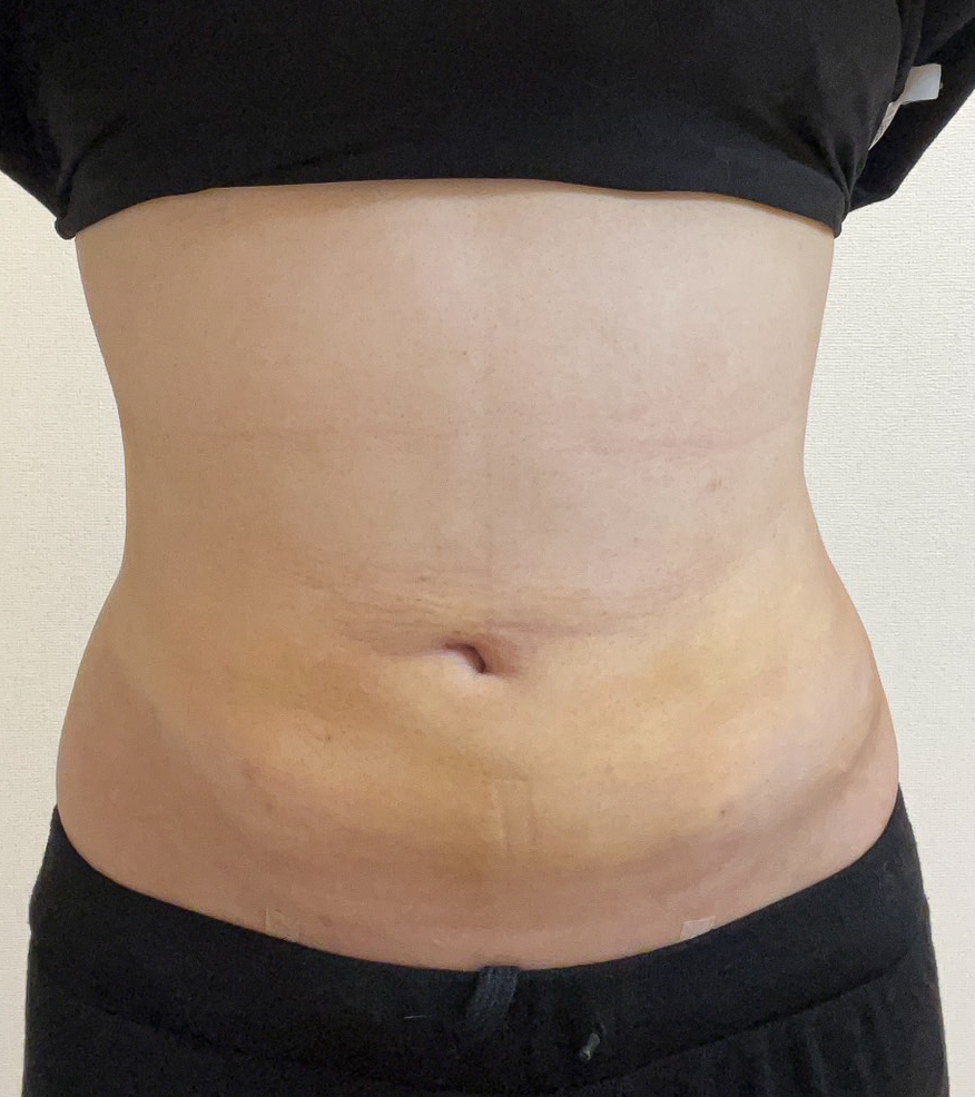 お腹の脂肪吸引