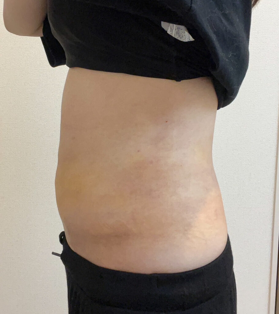お腹の脂肪吸引