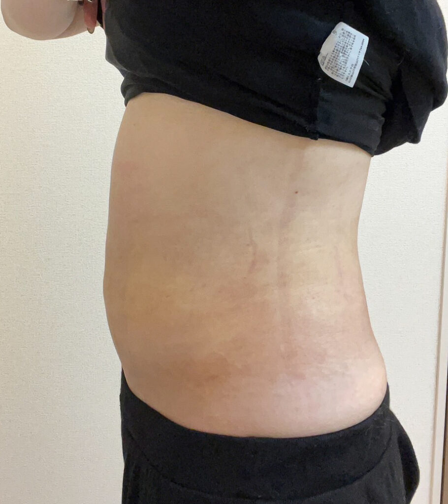 お腹の脂肪吸引