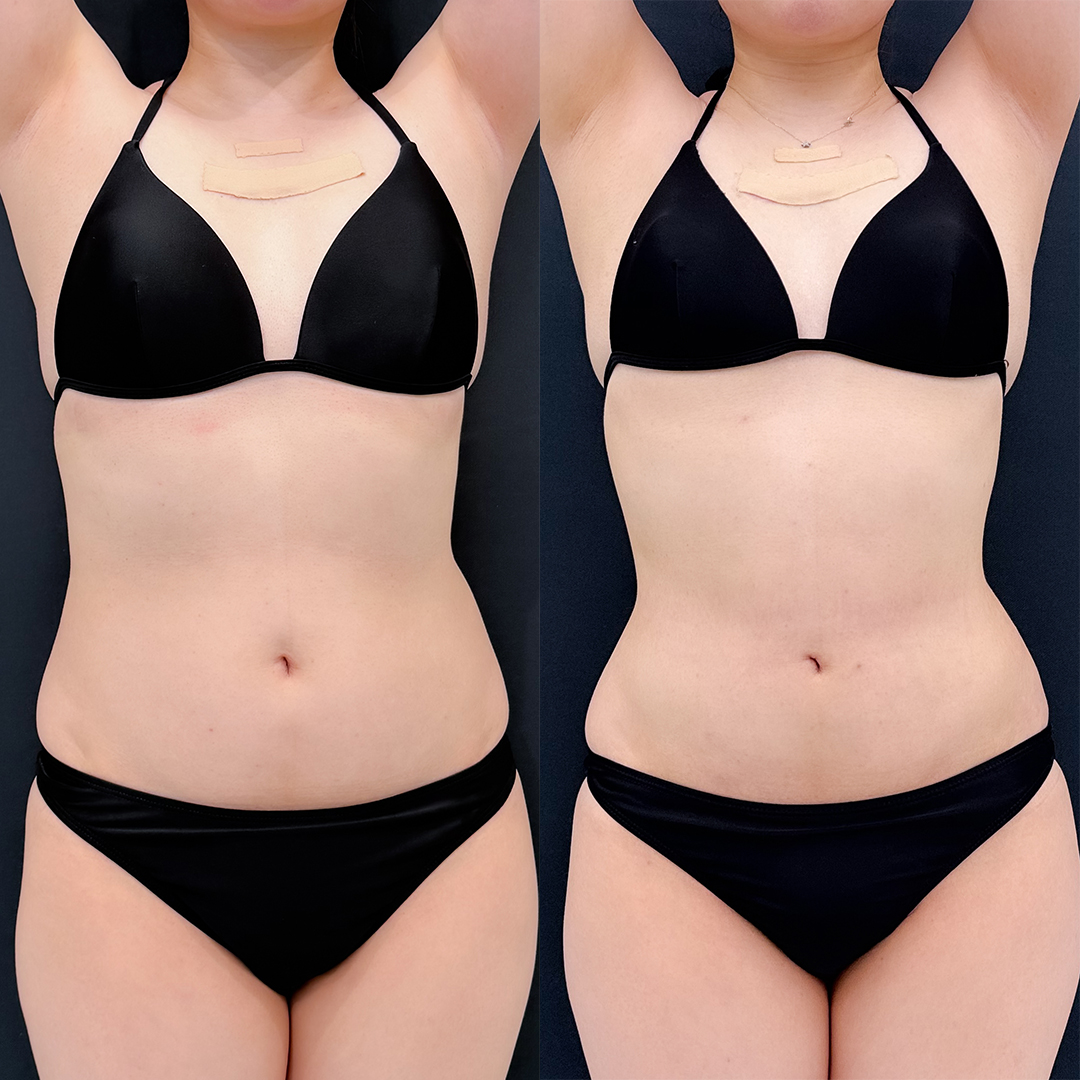 お腹の脂肪吸引