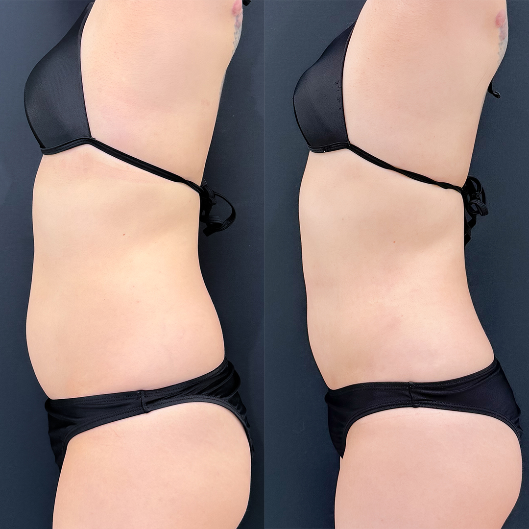 https://purelys-tokyo-clinic.com/wp/wp-content/uploads/2026/03/Before-and-After-abdominal-Liposuction_Case-No.388.jpg