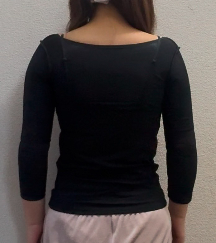 二の腕の脂肪吸引