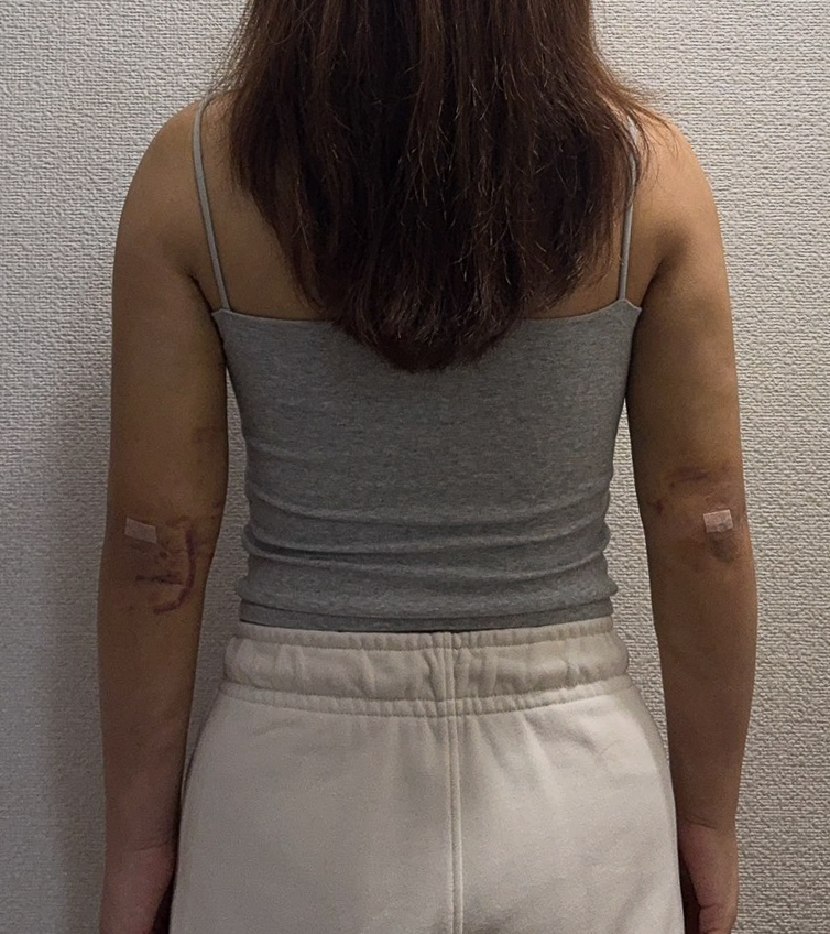 二の腕の脂肪吸引