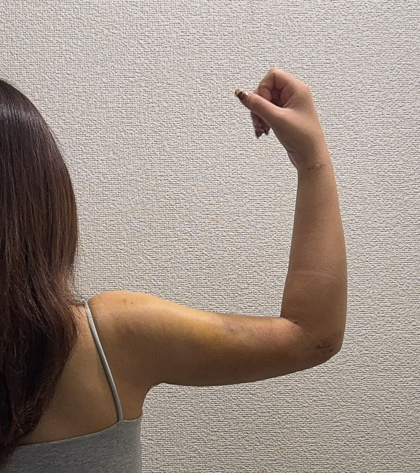 二の腕の脂肪吸引