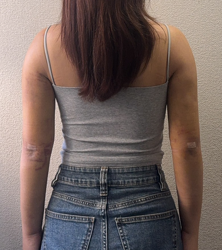 二の腕の脂肪吸引