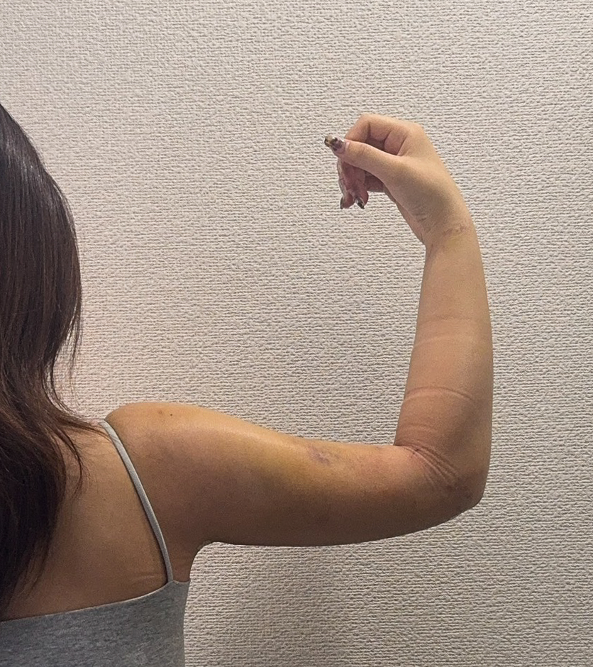 二の腕の脂肪吸引