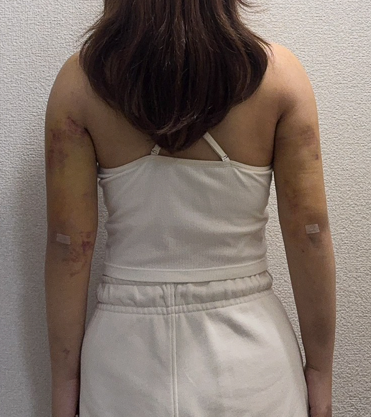 二の腕の脂肪吸引