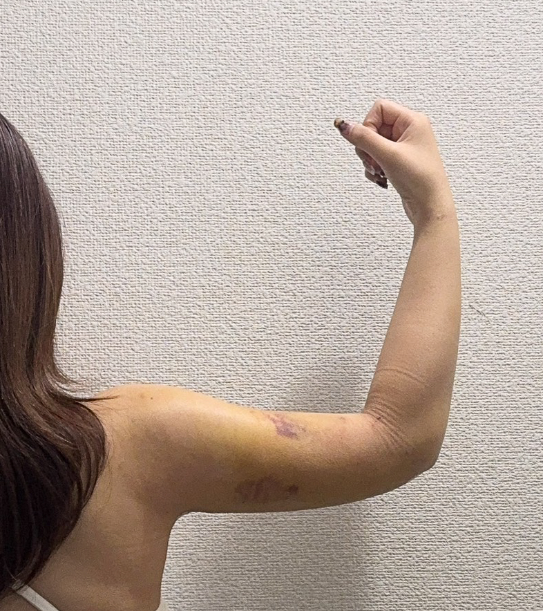 二の腕の脂肪吸引