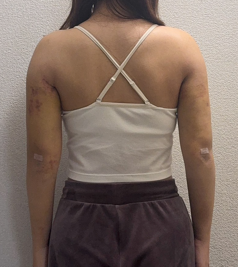 二の腕の脂肪吸引