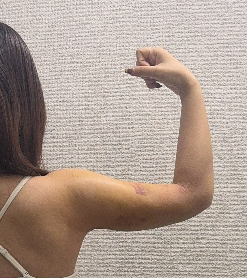 二の腕の脂肪吸引