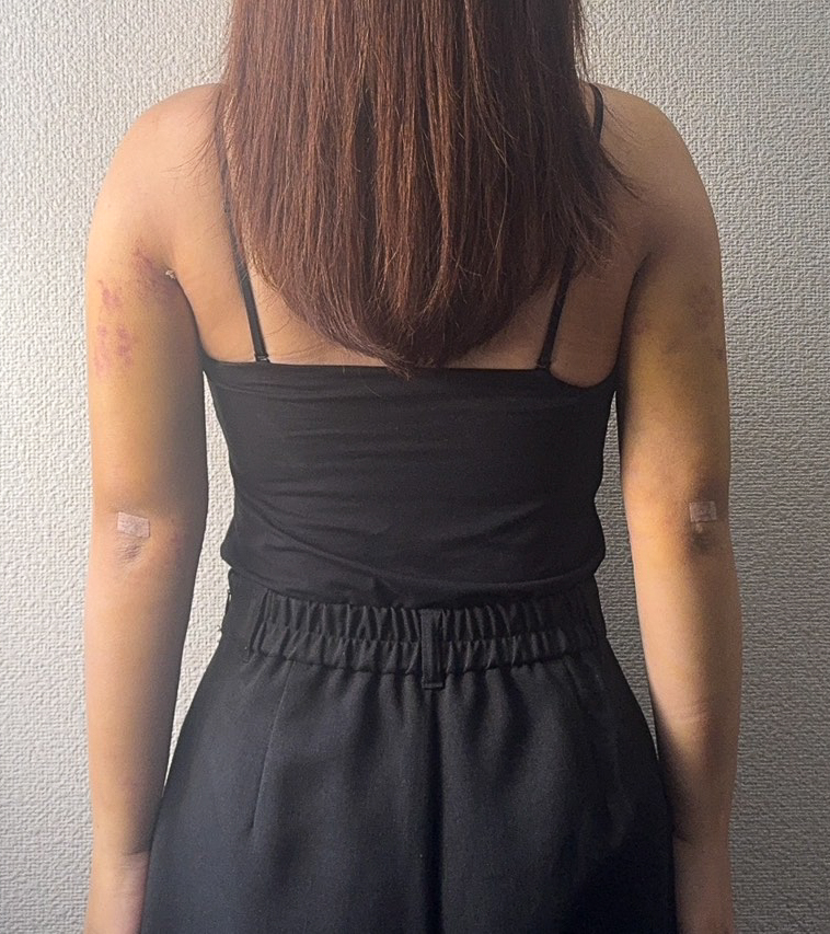 二の腕の脂肪吸引