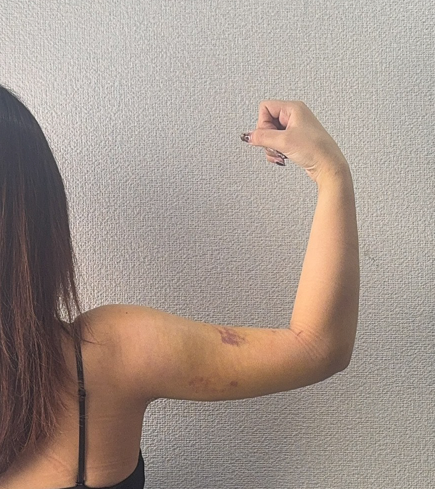 二の腕の脂肪吸引