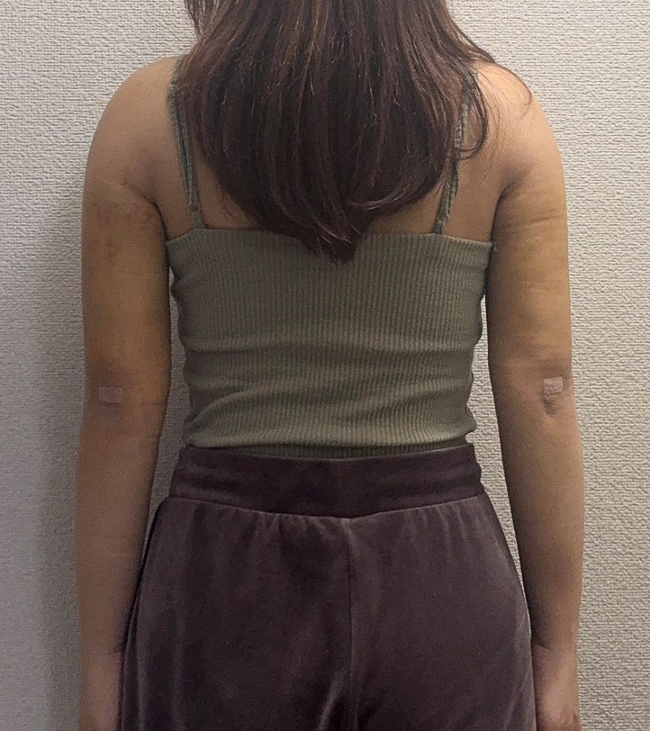 二の腕の脂肪吸引