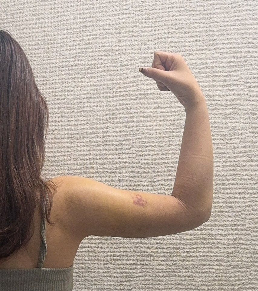 二の腕の脂肪吸引