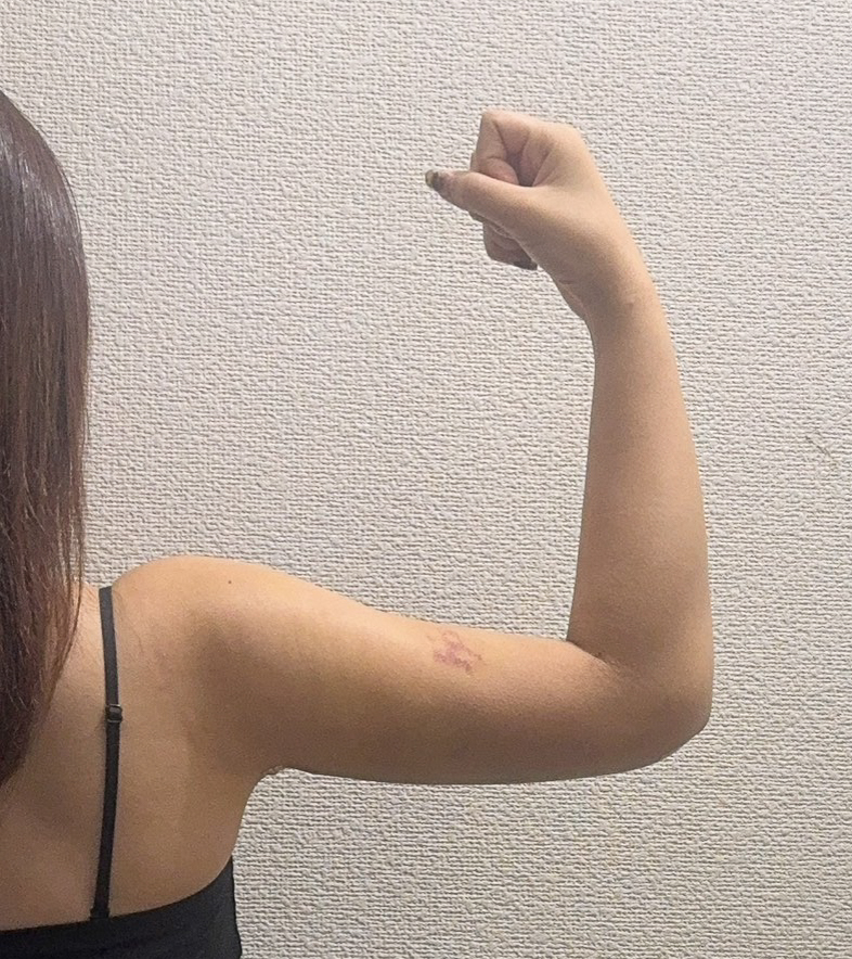 二の腕の脂肪吸引