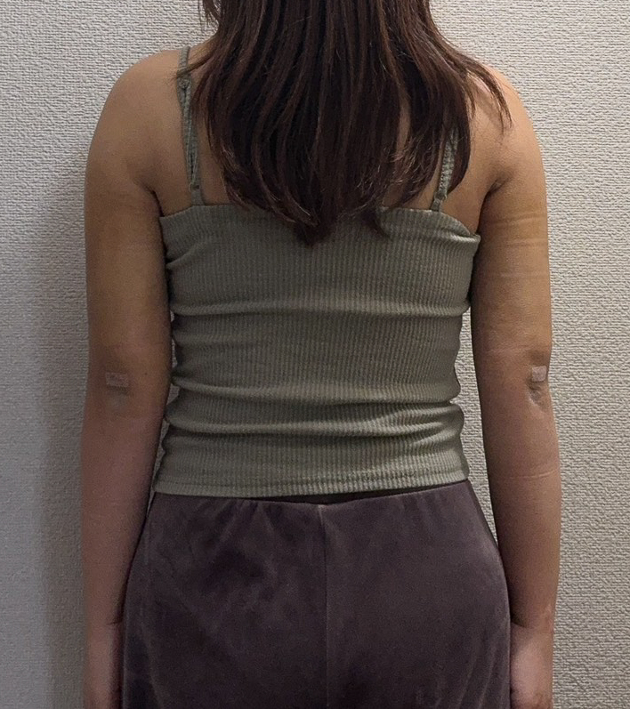 二の腕の脂肪吸引