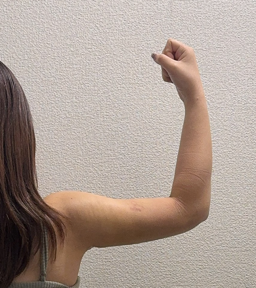 二の腕の脂肪吸引