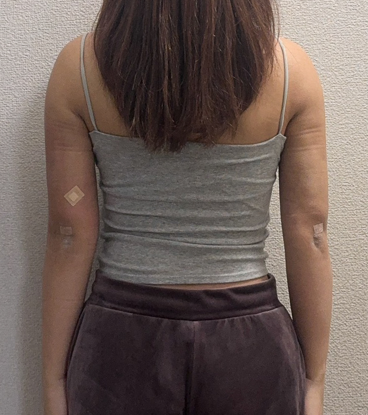 二の腕の脂肪吸引