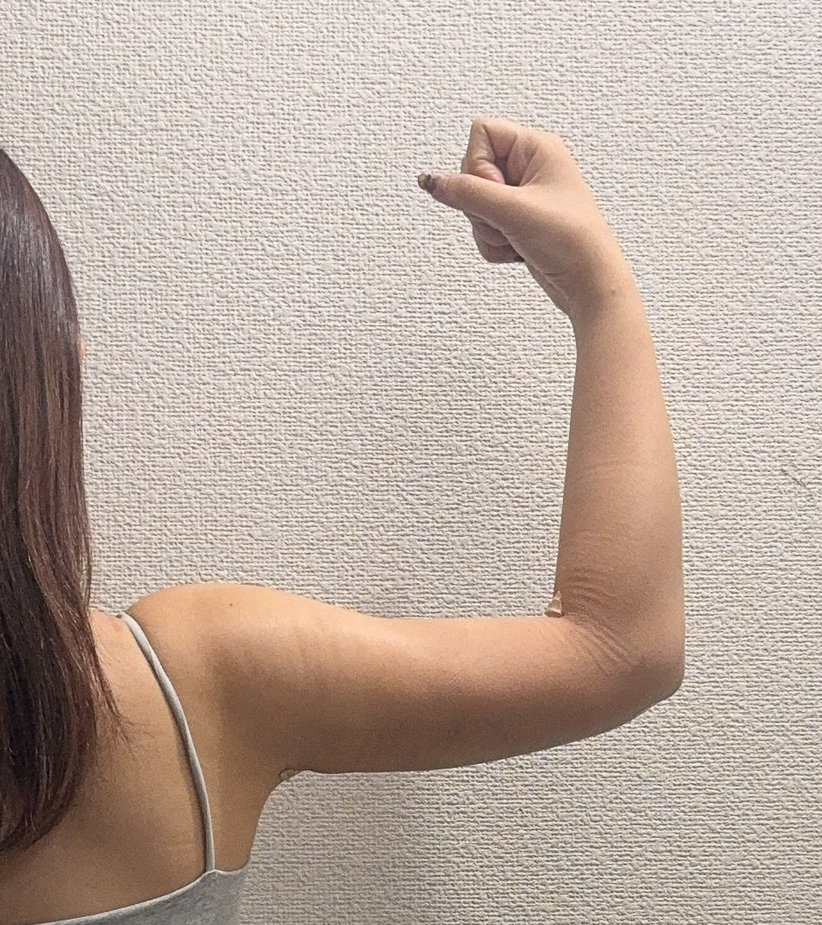 二の腕の脂肪吸引