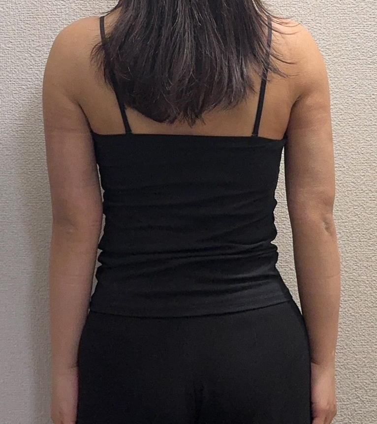 二の腕の脂肪吸引