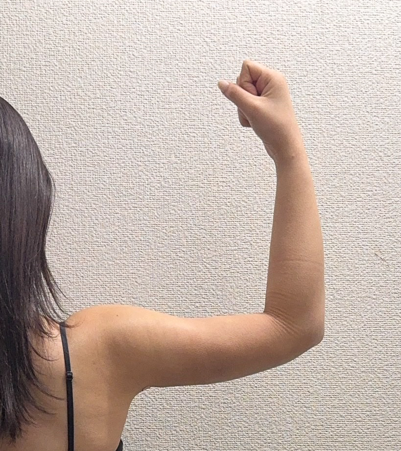 二の腕の脂肪吸引