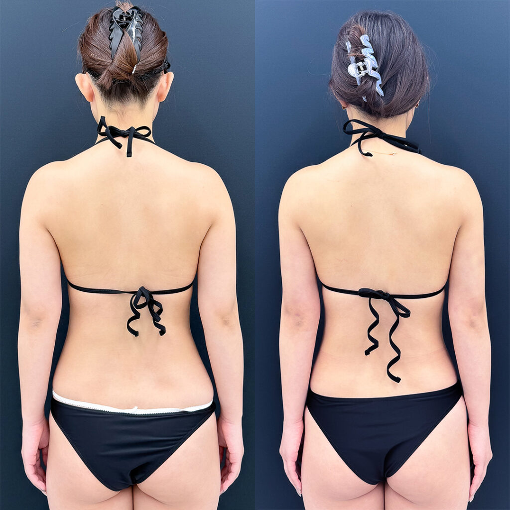 二の腕の脂肪吸引