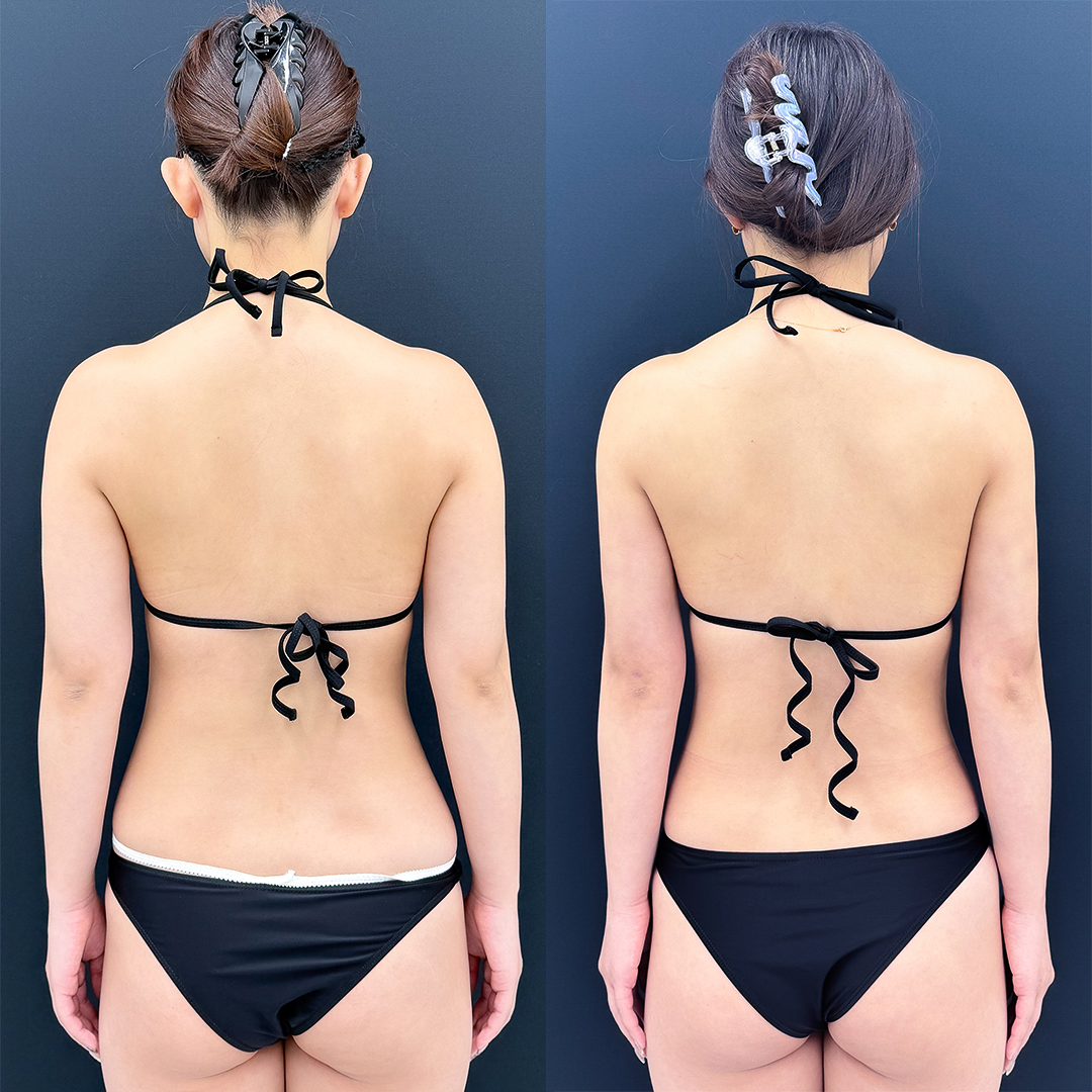 二の腕の脂肪吸引