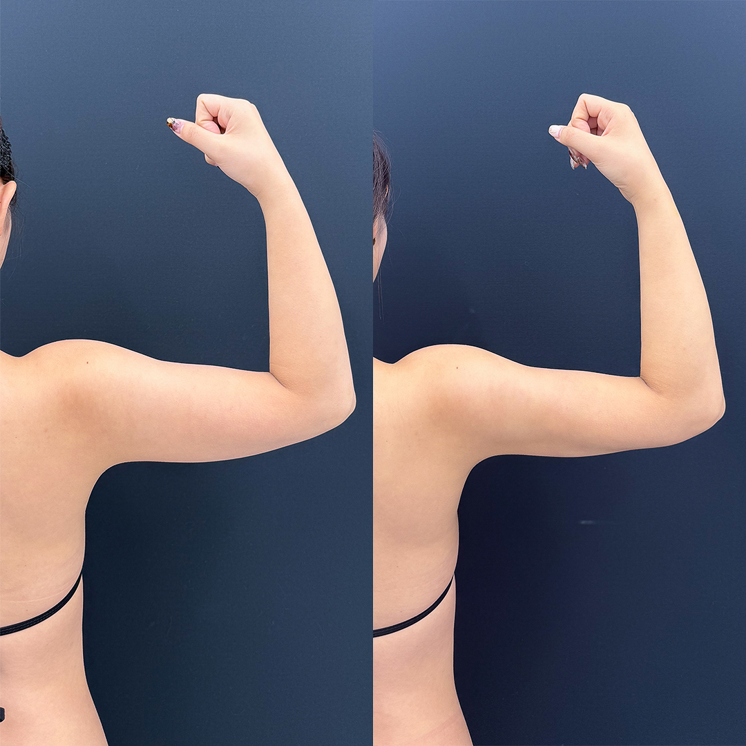 https://purelys-tokyo-clinic.com/wp/wp-content/uploads/2026/03/arm-Liposuction_Case-No.533.jpg