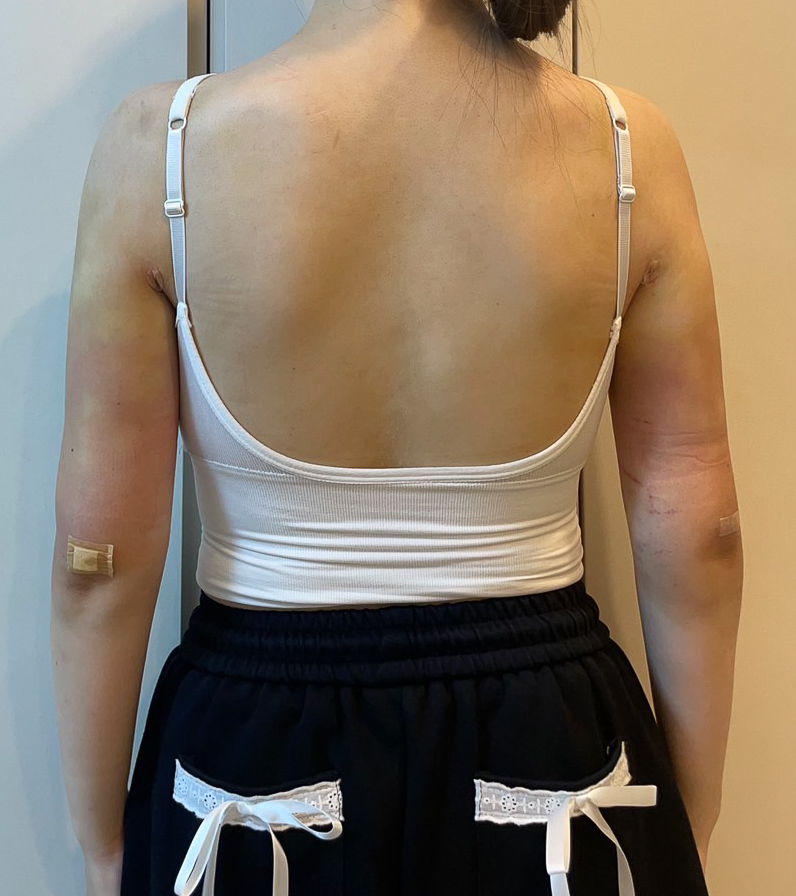 二の腕の脂肪吸引