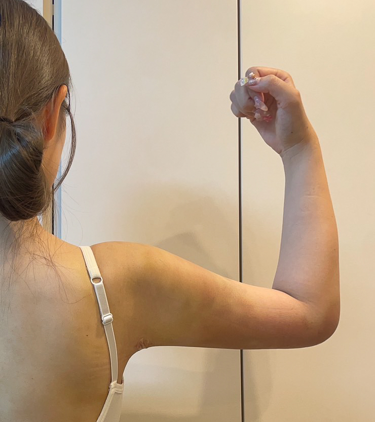 二の腕の脂肪吸引