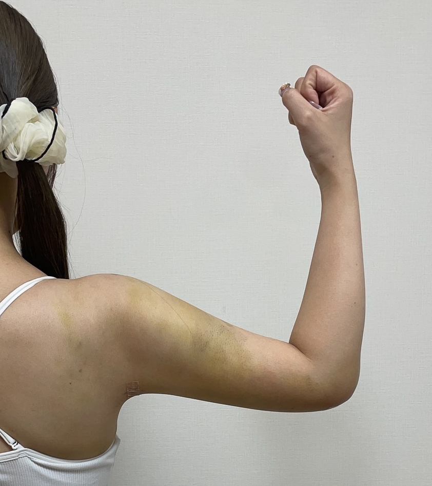 二の腕の脂肪吸引