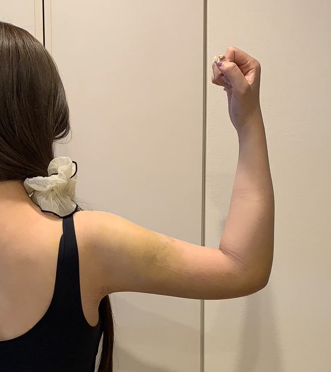 二の腕の脂肪吸引