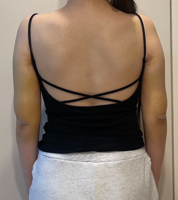 二の腕の脂肪吸引