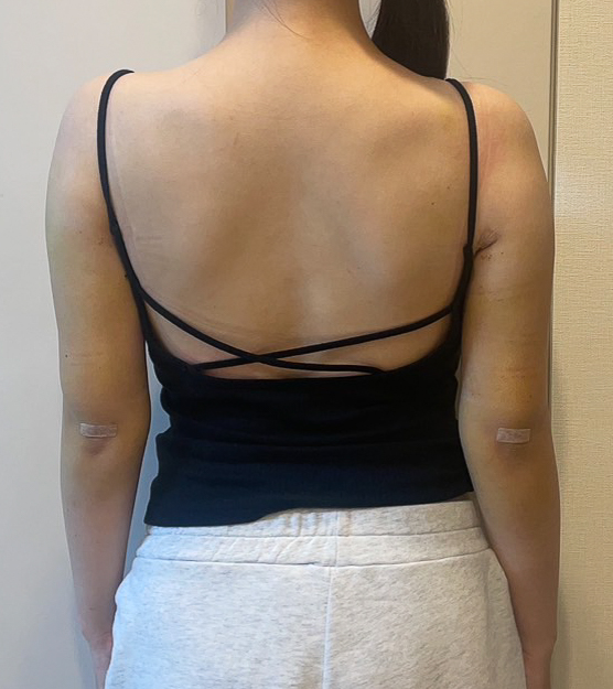 二の腕の脂肪吸引