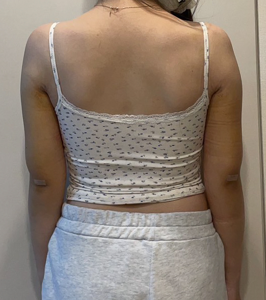 二の腕の脂肪吸引