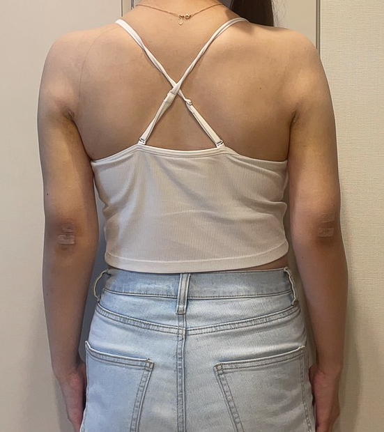 二の腕の脂肪吸引