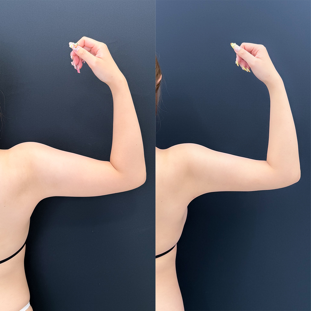 https://purelys-tokyo-clinic.com/wp/wp-content/uploads/2026/03/arm-Liposuction_Case-No.556.jpg
