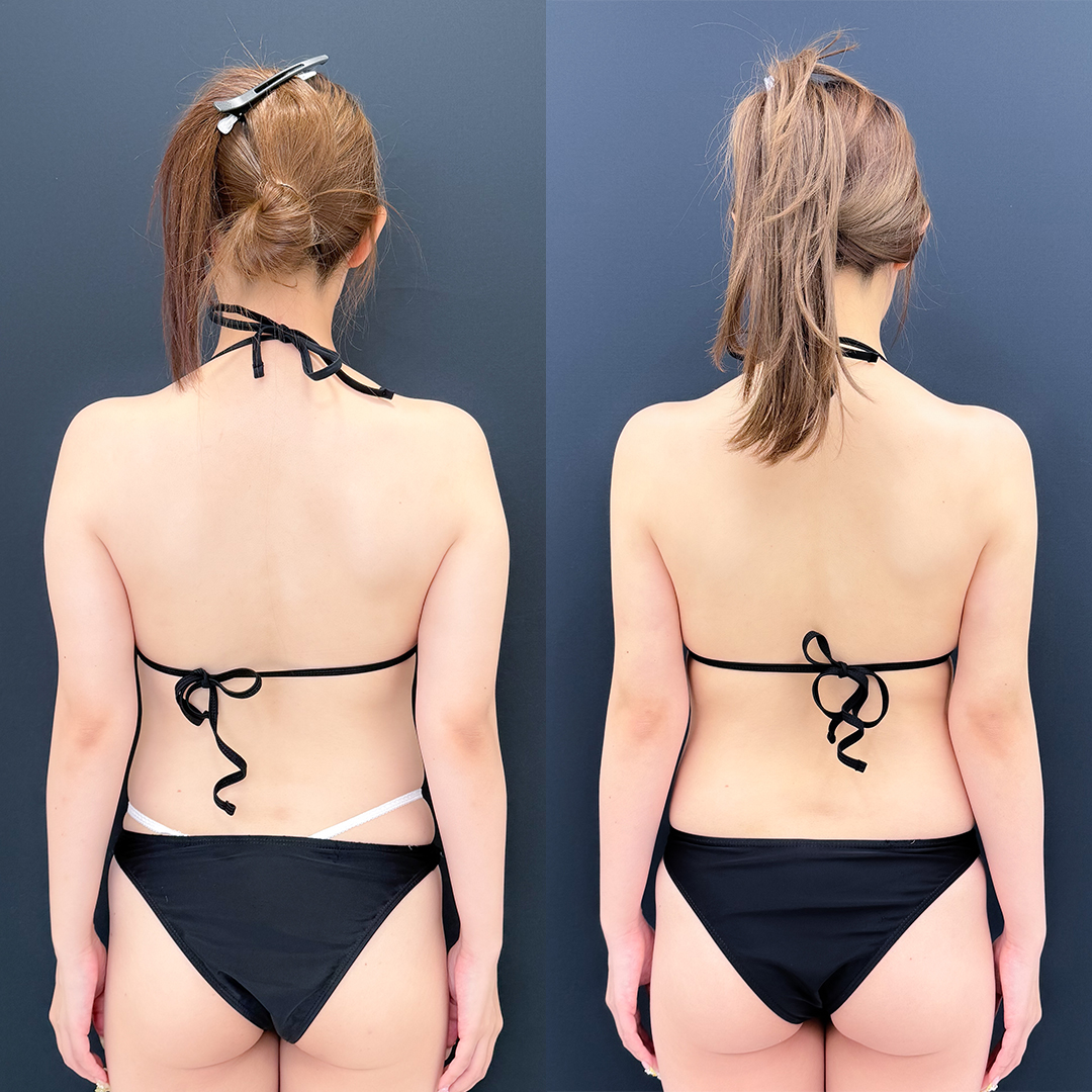 二の腕の脂肪吸引